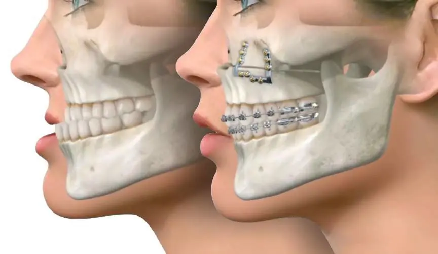 Surgery for Better Functionality
