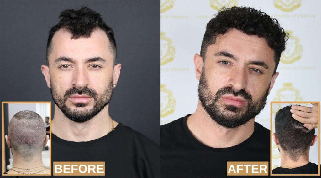 Best Top 10 Hair Transplant Clinics in Turkey
