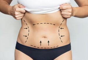 Thinking About a Tummy Tuck in Dubai Here's What You Need to Know
