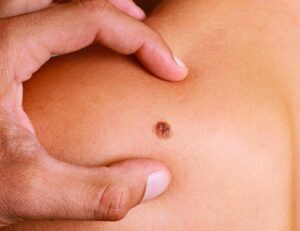 How a Skin Check in Caboolture Can Help Detect Skin Cancer Early